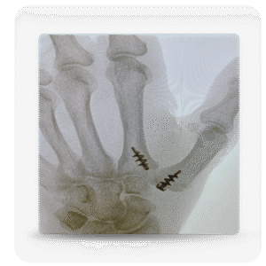 The Anchor Line CMC Suspensionplasty System - Adv